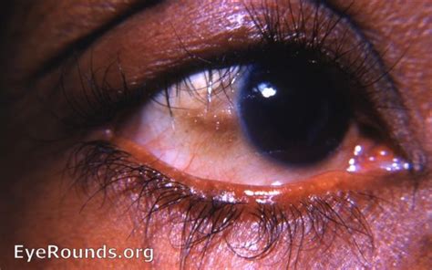 Trachoma. EyeRounds.org: Online Ophthalmic Atlas