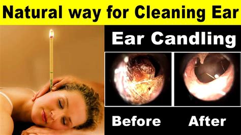 Ear Wax Removal Candle How Often at Jose Green blog