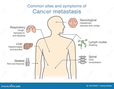 Most Common Sites And Symptoms Of Cancer Metastasis. Stock Vector ...