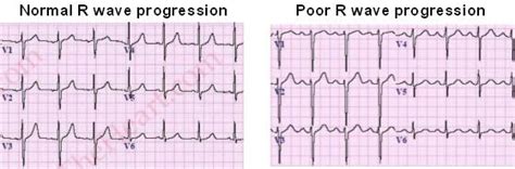 R Wave on a 12-lead ECG Tracing | LearntheHeart.com