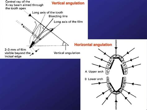 Bisecting angle technique