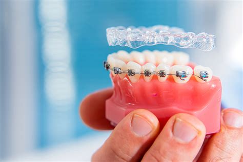 Invisalign vs. Braces; the Answer Is Clear!