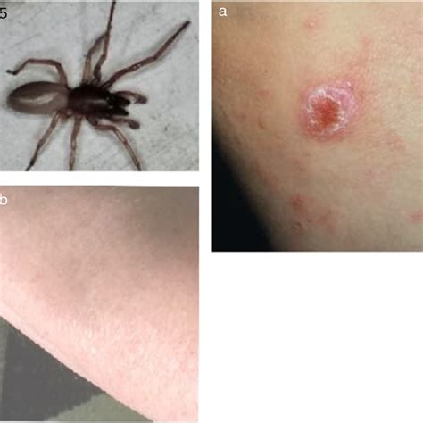 Wolf Spider Bite Identification