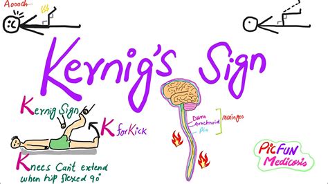 Kernig's Sign|How to perform Meningitis signs - YouTube