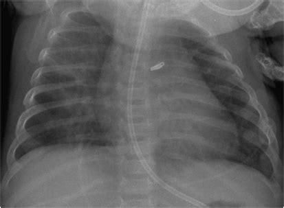 Chest X-ray showing resolution of the pneumatocele, 2 weeks after... | Download Scientific Diagram