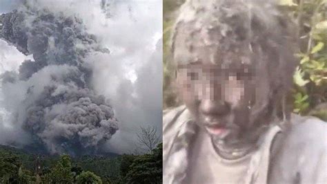 KONDISI Pilu Zhafirah, Korban Erupsi Gunung Marapi, Luka Bakar di Wajah, Tangan Patah: Gak Kuat ...