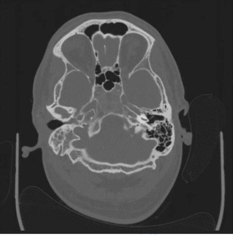 Axial CT image slice showing opacification of the right middle ear ...