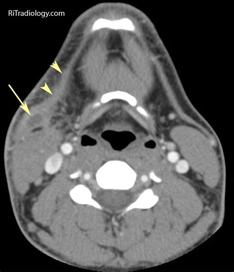 RiT radiology: Infected Second Branchial Cleft Cyst