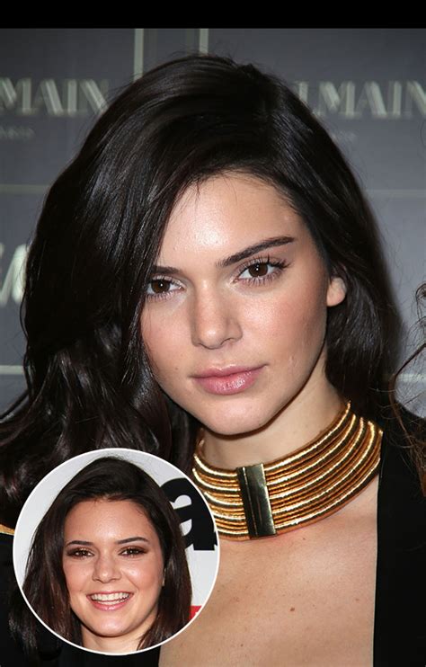 Kendall Jenner’s Acne — Opens Up About Suffering As A Teen – Hollywood Life