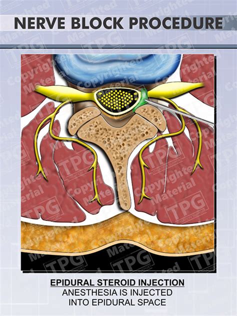 Epidural Nerve Block Procedure - Order