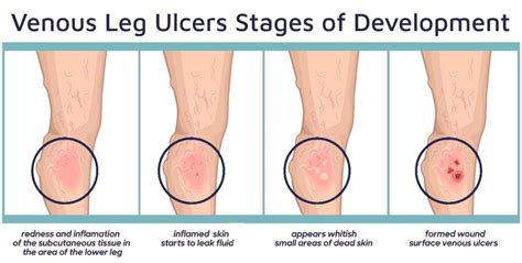 Why Not to Ignore a Leg Ulcer That Won’t Heal - Precision Vascular