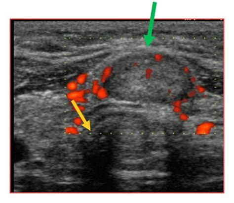 Follicular Thyroid Cancer Diagnosis