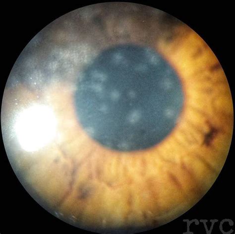 Nummular keratitis: •... - Ophthalmology-Notes And Synopses