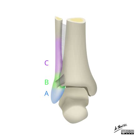 Weber classification of ankle fractures | Radiology Reference Article ...