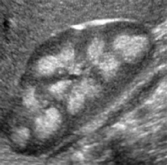 A Problem-Solving in a Case of Medullary Nephrocalcinosis