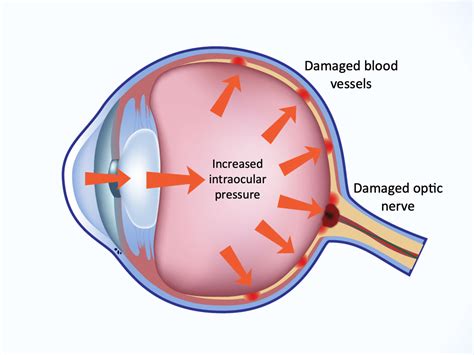 Glaucoma Eye Diagram