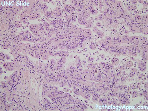 papillary rcc pathology