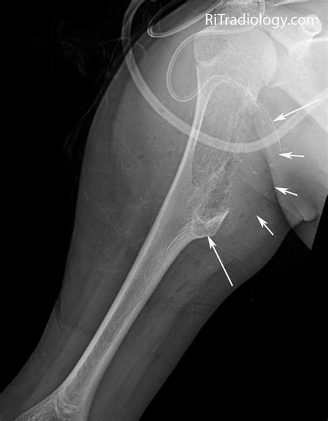 RiT radiology: Osteochondroma: Imaging Features of Malignant Degeneration