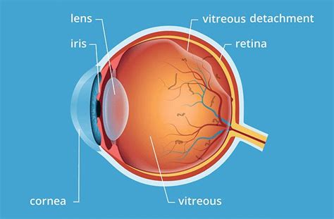 Vitreous Syneresis Treatment