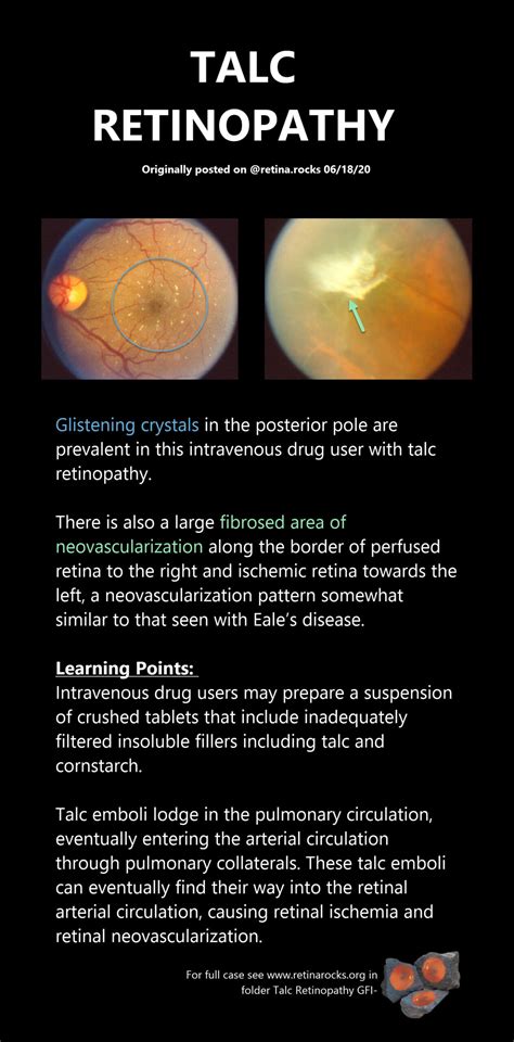 Toxic Disorders > Talc Retinopathy - Retina Rocks