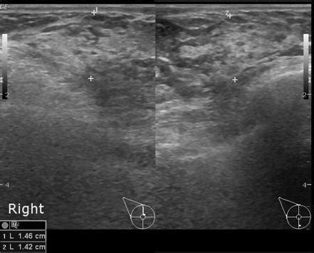 Gynecomastia | Radiology Case | Radiopaedia.org