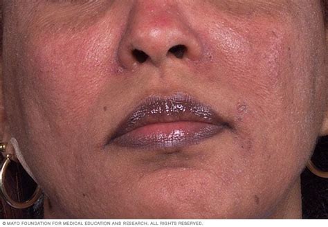 Rosacea - Symptoms and causes - Mayo Clinic