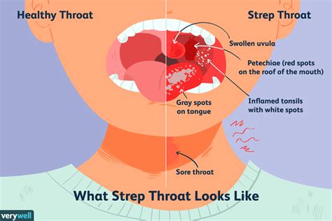 What Is The Difference Between Strep Throat And Cold? - Chance Phelps