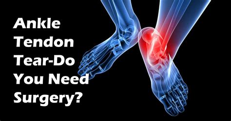 Do You Have an Ankle Tendon Tear? Most don't need surgery...