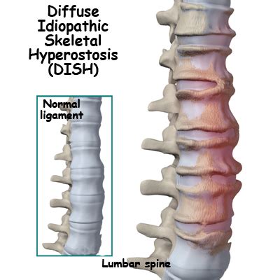 A Patient's Guide to Diffuse Idiopathic Skeletal Hyperostosis | Orthopaedic Clinic Singapore