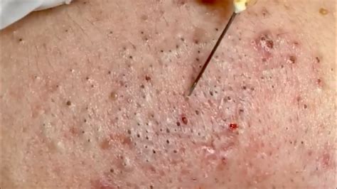 🔥 Pimple Popping 2020 Video| Blackheads extraction| Blackheads removal| Acne removal|Acne ...