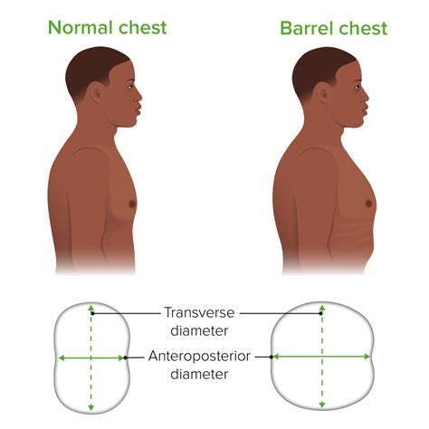 Chronic Obstructive Pulmonary Disease (COPD) | Concise Medical Knowledge