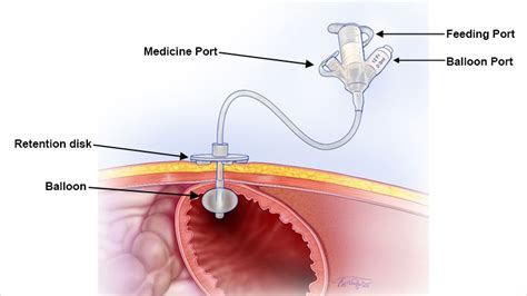 Gastrostomy Tubes (G Tube) Children's Hospital Of, 54% OFF