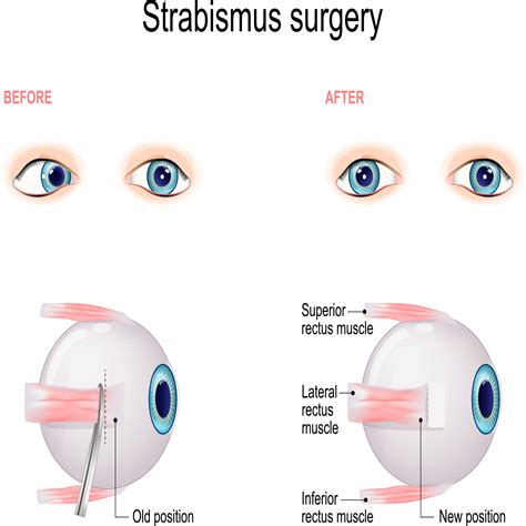 Strabismus Surgery (What to Expect & FAQ) | Vision Center