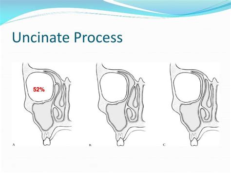 PPT - Principles of Functional Endoscopic Sinus Surgery PowerPoint ...