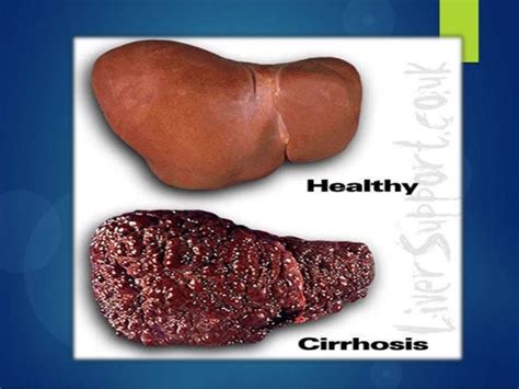 Alcoholic liver cirrhosis