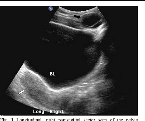 Sonographic appearance of canal of Nuck hydrocele | Semantic Scholar