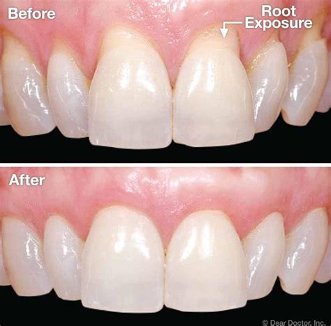 Gum Recession | Periodontal Disease Treatment Houston TX