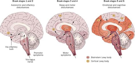 Lewy Body Disease - Physiopedia