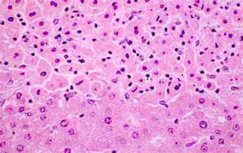 General Pathology I: Necrosis and Postmortem Autolysis Flashcards | Quizlet