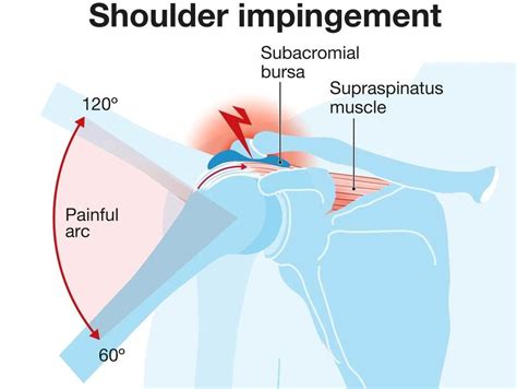 Shoulder Impingement Syndrome: Causes, Symptoms, & Treatment