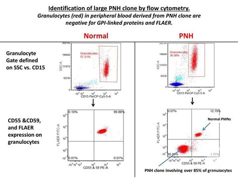 Paroxysmal nocturnal hemoglobinuria (PNH) Flow Cytometry