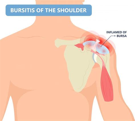 Shoulder Bursitis: Symptoms, Causes, Treatment, & More!: Elite Sports ...