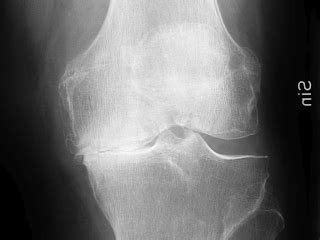 Knee osteoarthritis classification according to Kellgren-Lawrence | doi ...