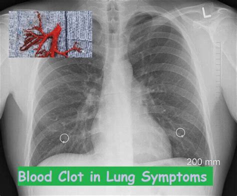 15 Blood Clot In Lung Symptoms, Causes, And Diagnosis [Pulmonary Embolism] » 2023