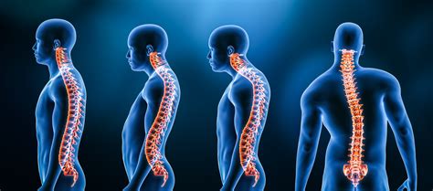 Three main curvatures of the spine disorders or deformities on male body: lordosis, kyphosis and ...