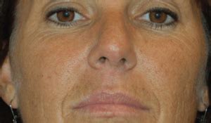 Micro Laser Peel Before and After Pictures Denver, Highlands Ranch, CO