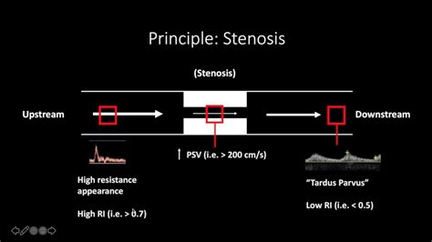 Doppler Ultrasound Part 1 - Principles (w/ focus on Spectral Waveforms) - YouTube