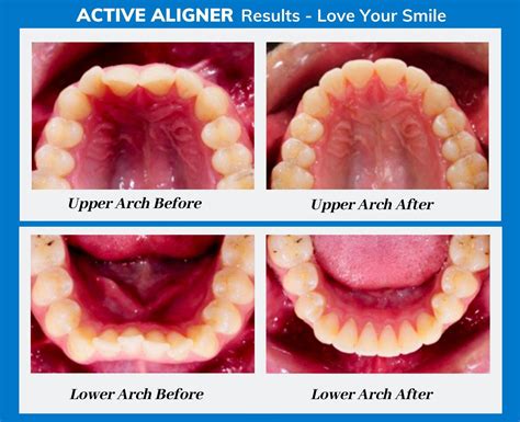 Interested in Active Aligners? Everything you need to know to get ...