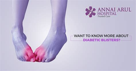 WANT TO KNOW MORE ABOUT DIABETIC BLISTERS? – Multispeciality Hospitals in Chennai