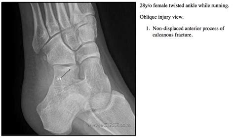 Calcaneous Fracture-Anterior Process S92.023A 825.0 | eORIF